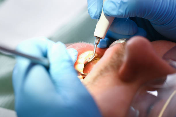 Best Dentist for Tooth Abscess  in Wellsville, MO